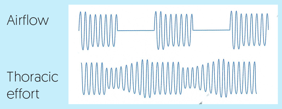 Obstructive sleep apnea: airflow stops while thoracic effort continues